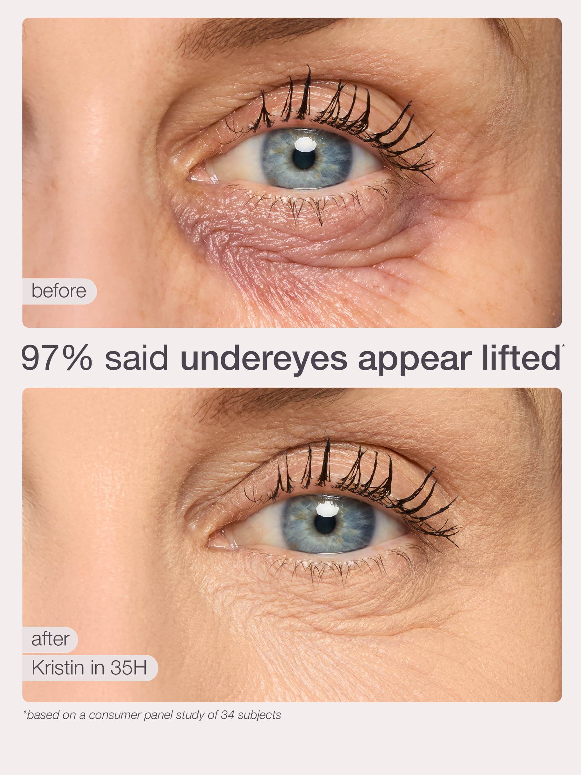 Before and after comparison of under-eye treatment on a person's eye, showing lifted under-eyes.